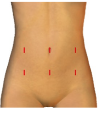 腹腔鏡下手術の創部
