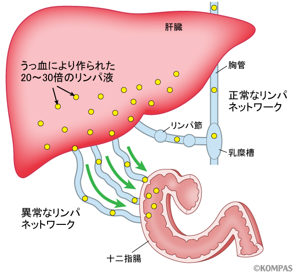 フォンタン手術後に起こる「難治性たんぱく漏出性胃腸症」への新しい治療―肝内リンパ管塞栓術―