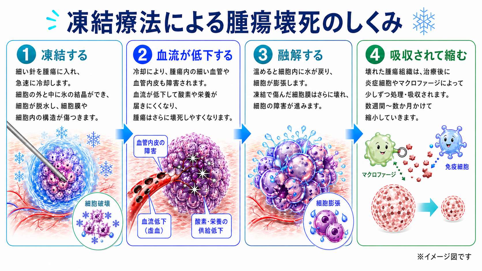 切らずに治す、からだにやさしい凍結療法：画像下治療の新たな選択肢